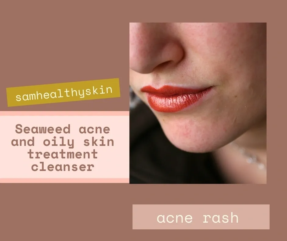 Seaweed acne treatment product advertisement