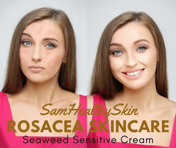 Rosacea skincare cream results on woman